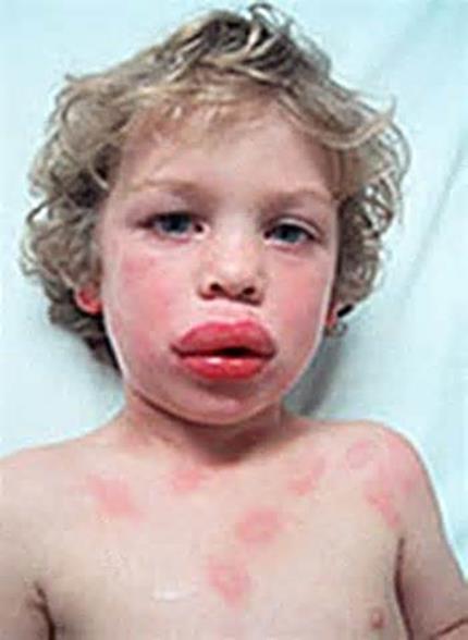 Anaphylaxis can be caused by a number of triggers Certain foods--eggs, nuts and chocolate are