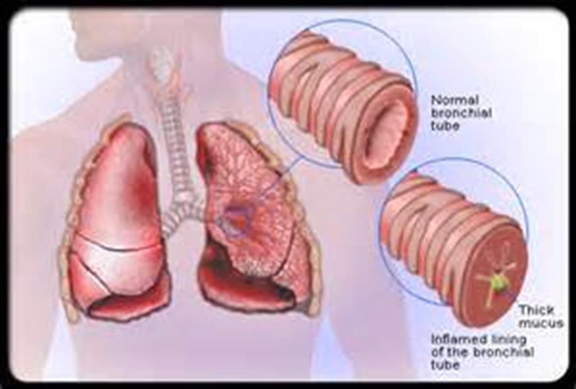 Bronchitis Condition resulting in inflammation of the lining of the trachea, bronchi