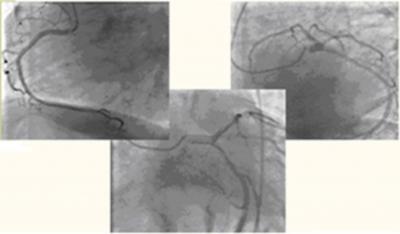 Figure 2 fig.2 Clear coronary arteries obtained for the placement of a pacing wire in the right ventricular apex and pigtail catheter in the aortic root.