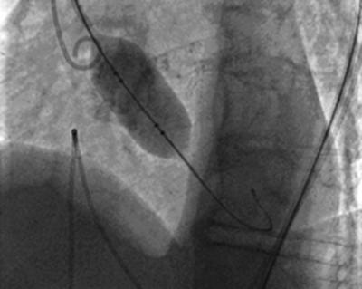 ). Figure 4 fig.4. Balloon valvuloplasty aortic valve Mean pressure gradient was 65 mmhg. Ileofemoral angiogram showed patent non-tortuous iliac and femoral arteries.(fig.3.) Figure 3 fig.