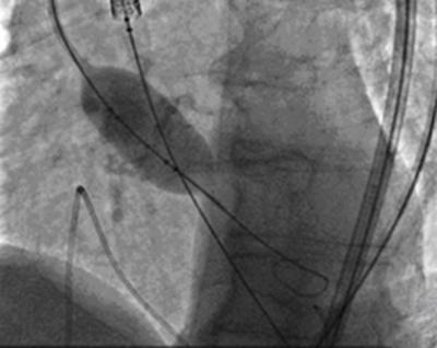 Figure 5 fig.5. Repeat balloon valvuloplasty aortic valve and attempt to cross the valve with the device Figure 7 