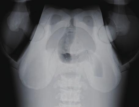 Radiate X-ray along median plane. trunk thigh * Not represented when using PBU-50.