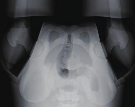 superior end of the pubic symphysis. Radiate X-ray along median plane.