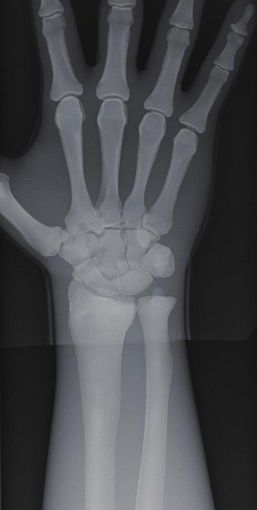 Arms radiography Frontal projection of hand and finger joints Point of X-ray