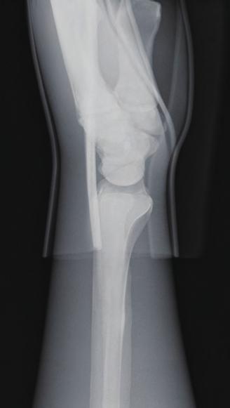 Xray image and the name of bone Align the center to the styloid process of radius.