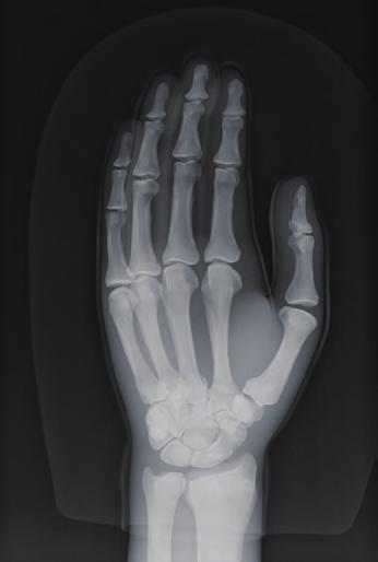 (In the case of the inclination of 30 degrees) Second distal phalanx DIP joint of 5th finger Second middle