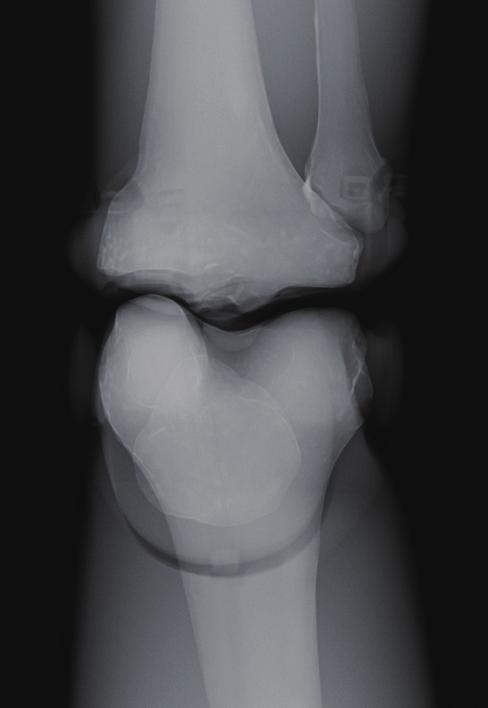 Lower limbs radiography Frontal projection of knee joint Point of X-ray