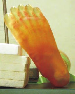 the lateral malleolus.