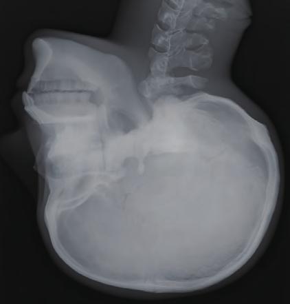 head Anterior clinoid process of Turkish saddle Greater wing of sphenoid bone Nasal bone Frontal process