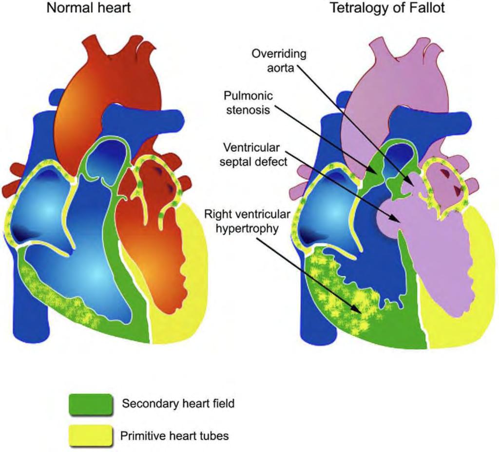 The second heart field and conotruncal congenital heart