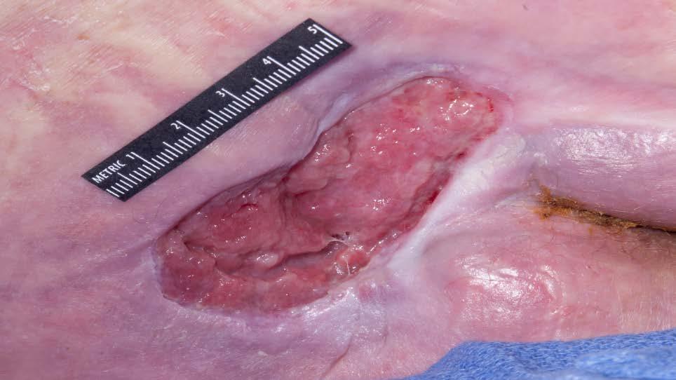 Category/Stage 3 Full thickness tissue loss, subcutaneous fat may be visible Highlights: 1.