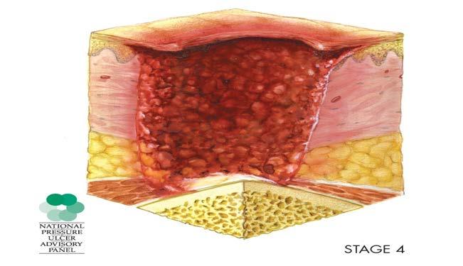 Category/Stage 4 Full thickness tissue loss with exposed