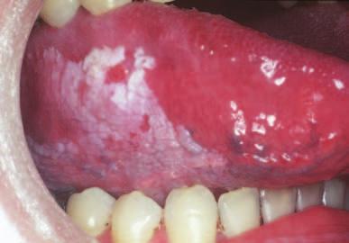 IN BRIEF Most white lesions in the mouth are inconsequential and caused by friction or trauma. However, cancer and some systemic diseases such as lichen planus and candidosis may present in this way.