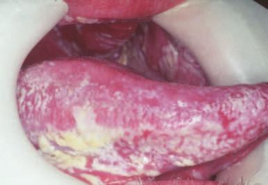 Fig. 4 Pseudomembranous candidosis Some 50% of the normal healthy population harbour (carry) C.