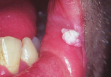 albicans causes lesions and these can be mainly white lesions; (thrush particularly; Fig. 4) or candidal leukoplakia (Fig.