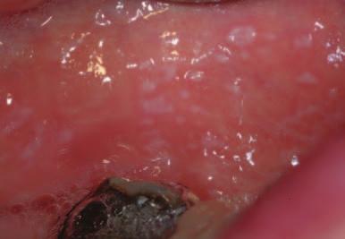 Keypoints for dentists: Keratosis (leukoplakia) Biopsy is mandatory in high risk lesions or high risk patients.