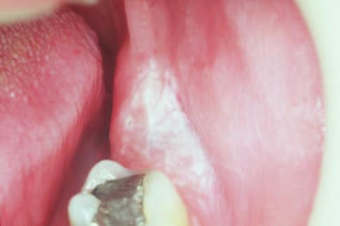 syndrome. Patients with missing teeth may develop keratosis on the alveolar ridge (Figs 15 and 16).