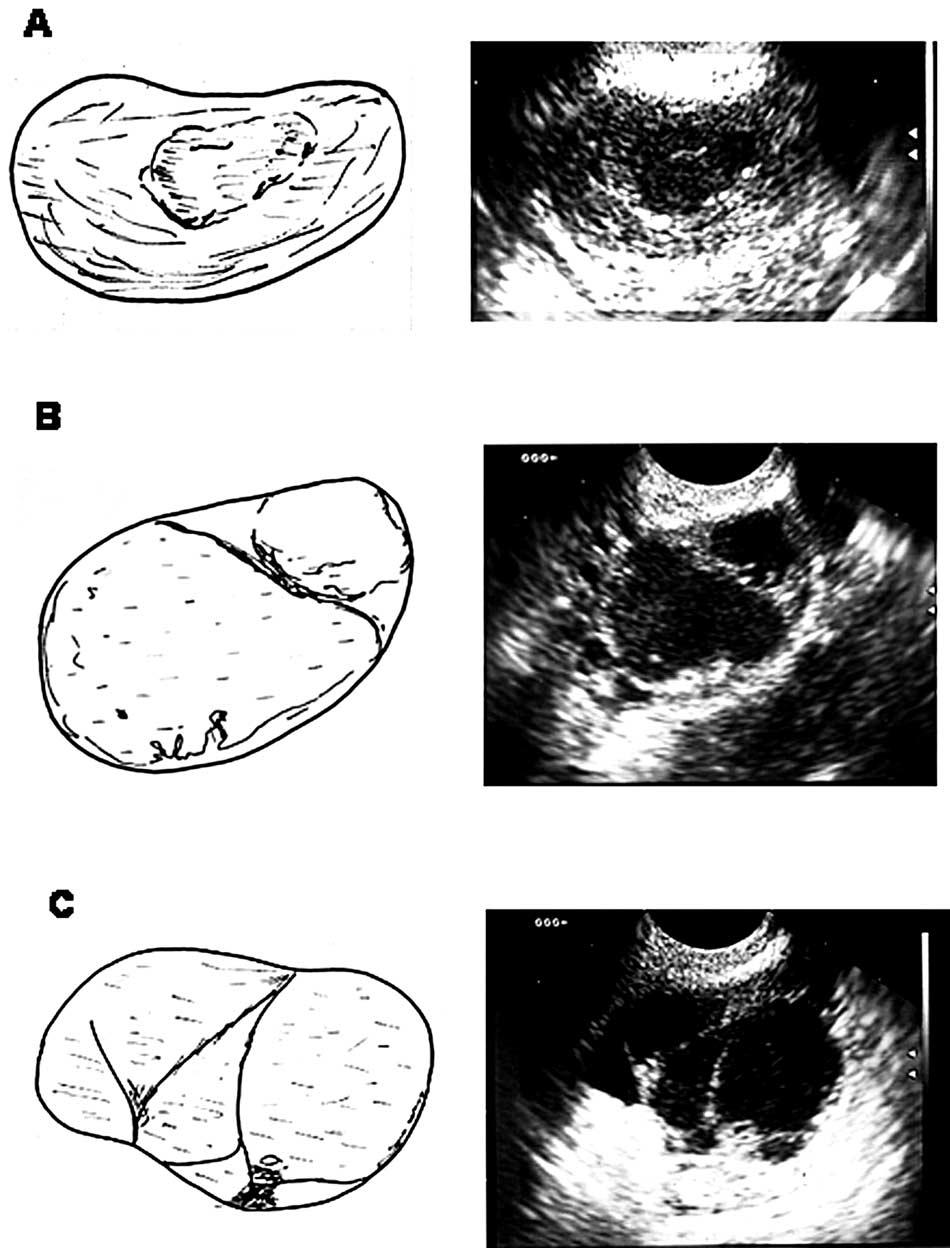 cant [NS]) (Fig. 1). At ultrasound scan, endometrioma recurrence was found in 40 women in group A and in 5 women in group B.