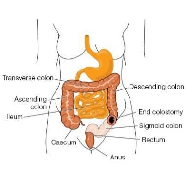 Types of Surgery Colostomy Surgeons attach the colon to the abdominal wall through a hole called a stoma (or opening).