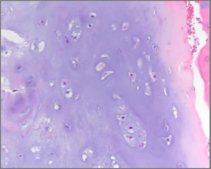 Mitoses Enchondroma Clear cell