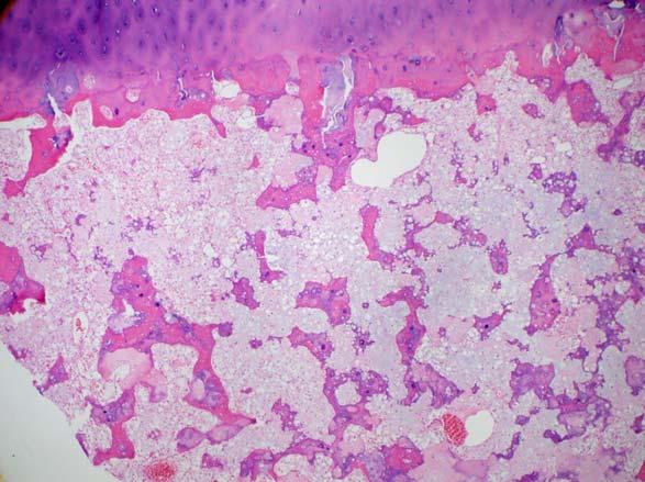 Small round blue cell tumor HPC-ish vessels common CD99, S100*, desmin Ewing sarcoma
