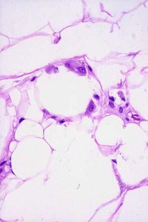 fibrous septae Adipocyte variability Histiocyte