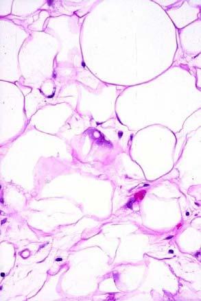 lipoblasts Lochkern cells Enlarged adipocyte nucleus