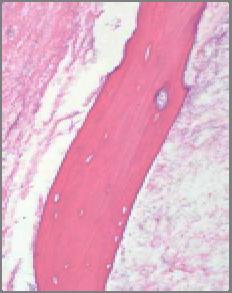 Neoplasms Low grade osteosarcoma