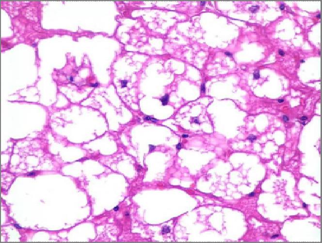 Hibernoma Multivacuolated brown fat cells mimic