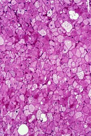 tumor, in particular liposarcomas Angiomyolipoma