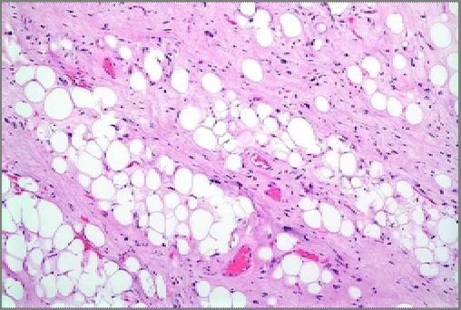 Triphasic histology Abnormal thick walled vessels