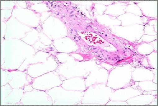 histologically low-grade, resembling