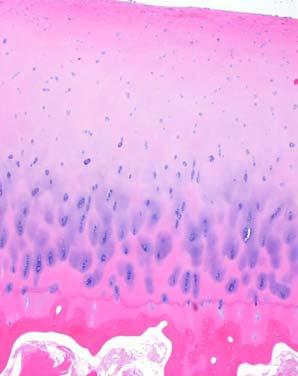 Cartilage: what is normal Widely dispersed chondrocytes Small, dark