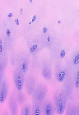 bizzare chondrocytes Myxoid matrix solid hyaline matrix USCAP 2015 Common