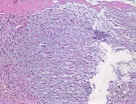 Mesenchymal chondrosarcoma Clear cell chondrosarcoma (Chondroblastoma to be