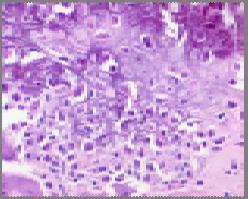 atypia in mononuclear cells diagnostic