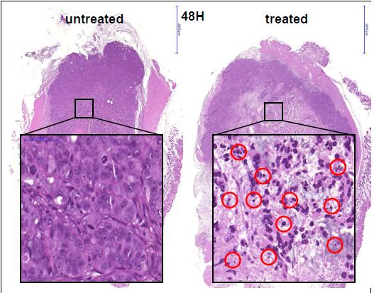 analysis. (see Figure 6.) Tunel assay proved the apoptotic cell death (see Figure 7.). Prsence of apoptotic bodies in a destructed tumor tissue is essential to induce immunogenic reactions by apobody phagocytosis.