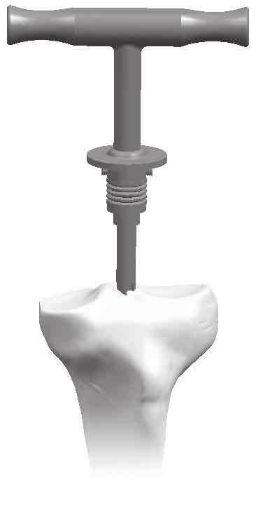 Insert the fluted IM reamer/rod into the tibial canal; constantly turning the T-handle (Figure 5).