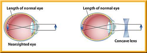 2 The Senses Correcting Vision Problems A nearsighted person cannot see distant objects