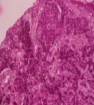 9: Basal Cell Carcinoma
