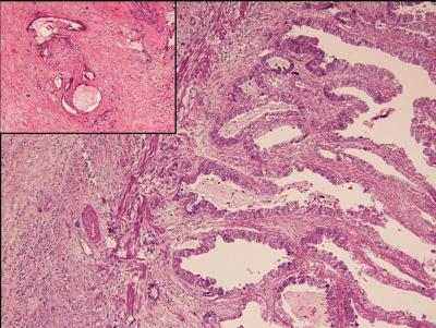 Figure 3 Figure 3: Papillary adenocarcinoma gallbladder (H&E, x200); inset showing perineural invasion.