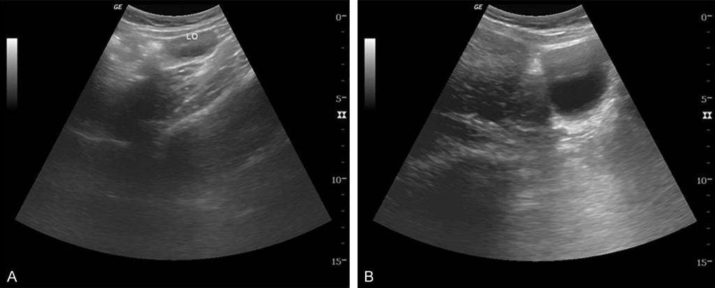 Figure 1. Ultrasonographic findings of the tumor. A huge solid mass without cystic contents is shown in pelvic cavity, which is attached to the right adnexa and uterine serosa (A).