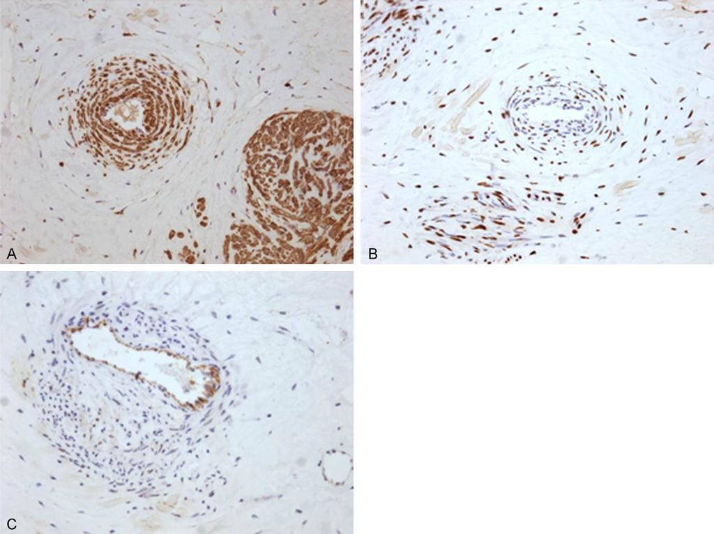 Figure 3. Immunohistochemical characteristics of the tumor. The spindle cells express diffused α-smooth muscle actin (α-sma) (A).