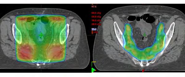 Rectal Cancer IMRT Improved target coverage, homogeneity, and conformality, while lowering dose to adjacent