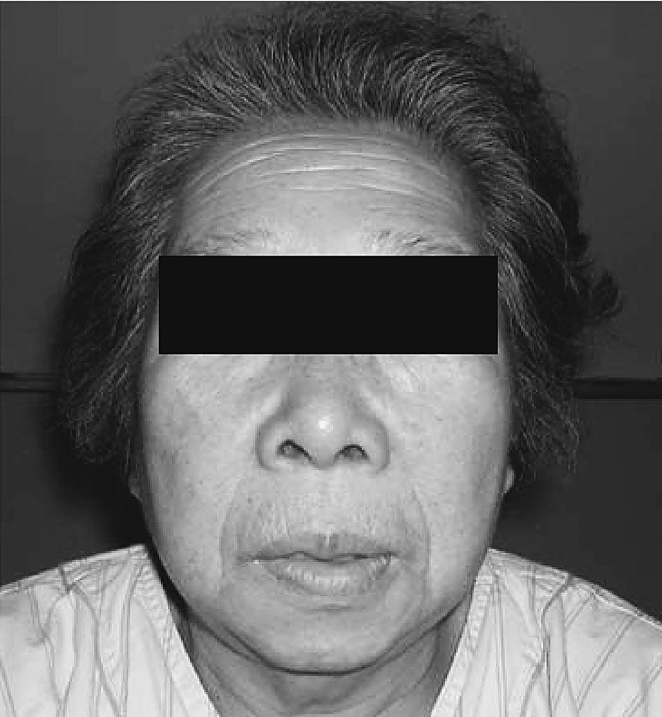 Pre-Clinical Acromegaly 293 cases, basal plasma GH levels were less than 1 ng/ml, while serum IGF-I levels were elevated above the normal range for each patient, compared with age- and