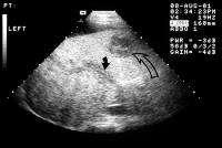 Investigation: Radiology PVT: Image shows ascites and a bright liver (fatty).