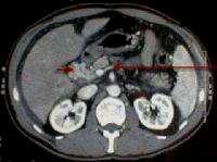 Investigation: Radiology PVT with cavernous transformation.
