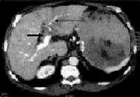 Investigation: Radiology Hepatocellular carcinoma with PVT.