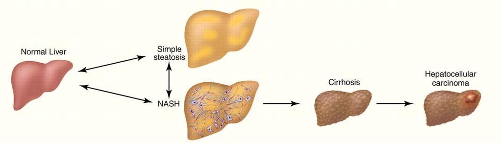 Unmet Need: Madrigal Aims to Treat Patients with NASH, a Large and Underserved Population NASH is the most severe form of nonalcoholic fatty liver disease (NAFLD) Characterized by inflammation and