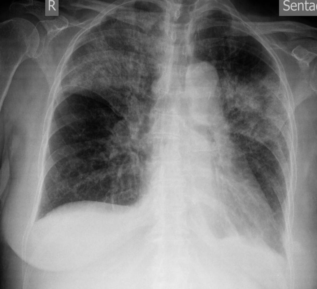 Fig. 5: Chest X-ray: Bilateral alveolar opacities